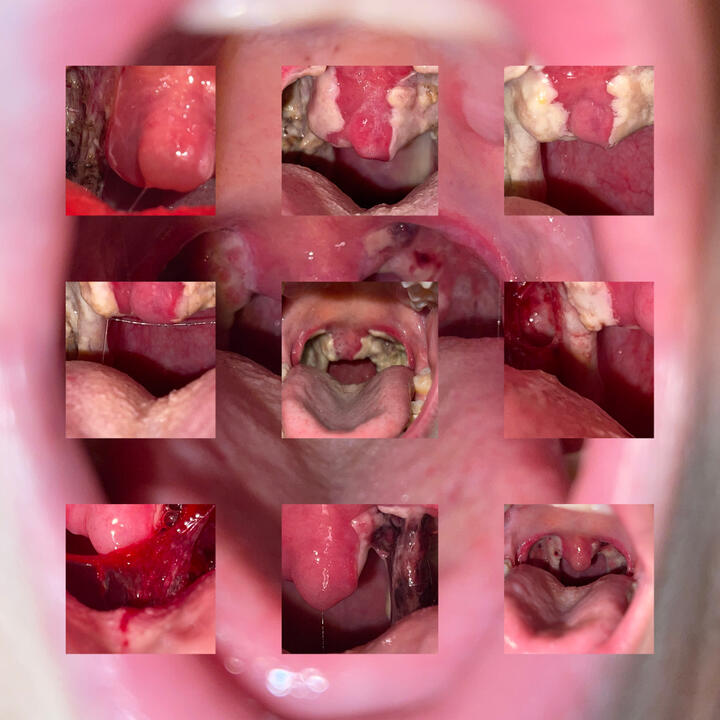 tonsils
