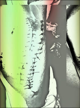 suture - dissolving 2