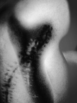 suture - scar suture - scar