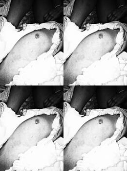 suture - preop 2 suture - preop 2