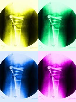suture - evidence suture - evidence