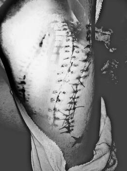 suture - dissolving 1